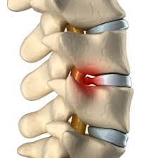 Slip Disc Treatment in Delhi NCR Dr. Manoj Kumar Best Spine Surgeon in Delhi