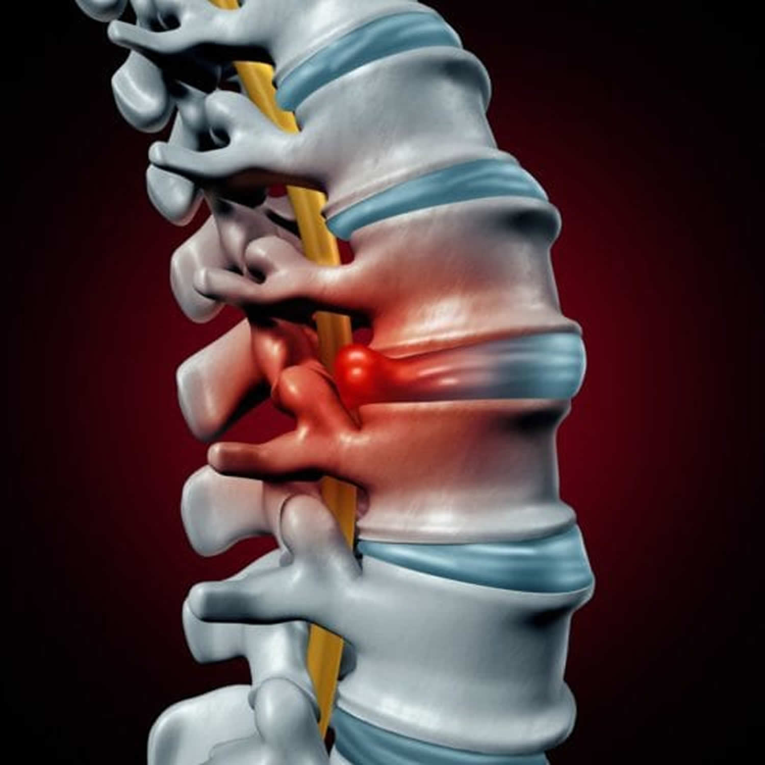 Dr. Manoj Kumar - Best Herniated Disc Treatment in Delhi Best Herniated Disc Treatment in Delhi | Dr. Manoj Kumar | Best Spine Specialist in Delhi