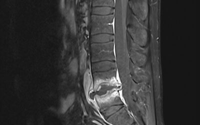 Spondylodiscitis