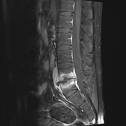best spondylodiscitis treatment in Delhi NCR | Dr. Manoj Kumar