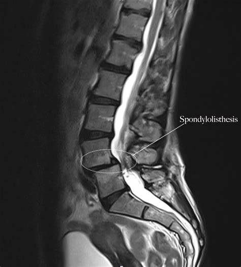 best spondylolisthesis treatment in Delhi NCR | Dr. Manoj Kumar