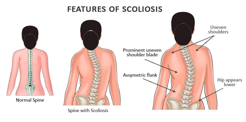 Best Scoliosis Treatment in Delhi NCR | Signs of Scoliosis | Dr. Manoj Kumar | Best Spine Specialist in Delhi
