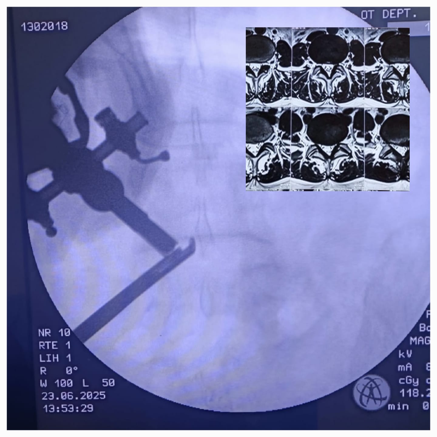 Successful Endoscopic Spine Surgery Case for L4-L5 Nerve Compression Treatment | Dr. Manoj kumar | Best Spine Specialist in Delhi