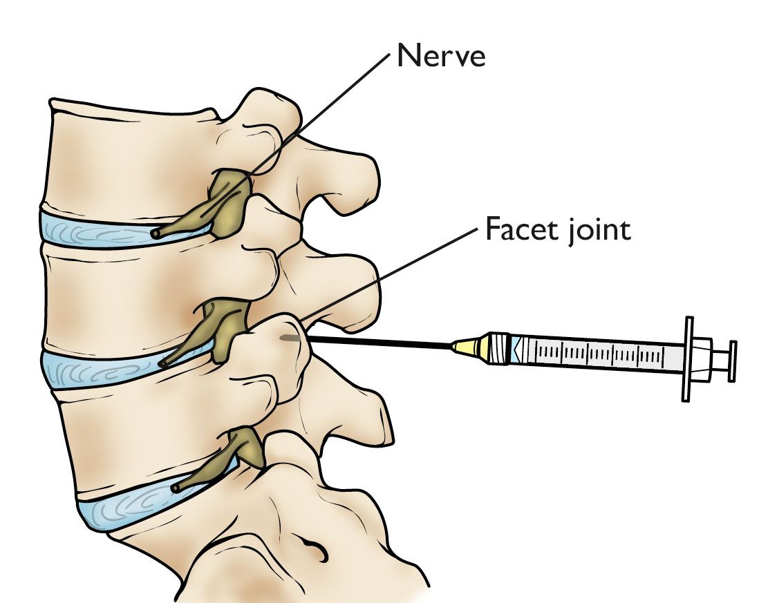 Best Spinal Injection Treatment in Delhi NCR | Dr. Manoj Kumar | Best Spine Specialist in Delhi