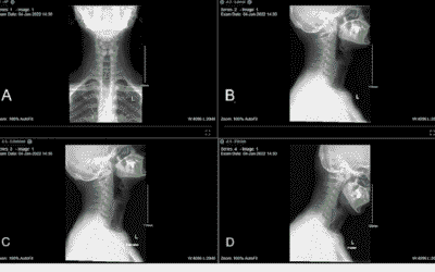 Straightening of the Cervical Spine Treatment