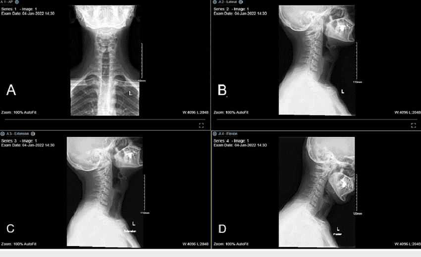 Straightening of the Cervical Spine Treatment